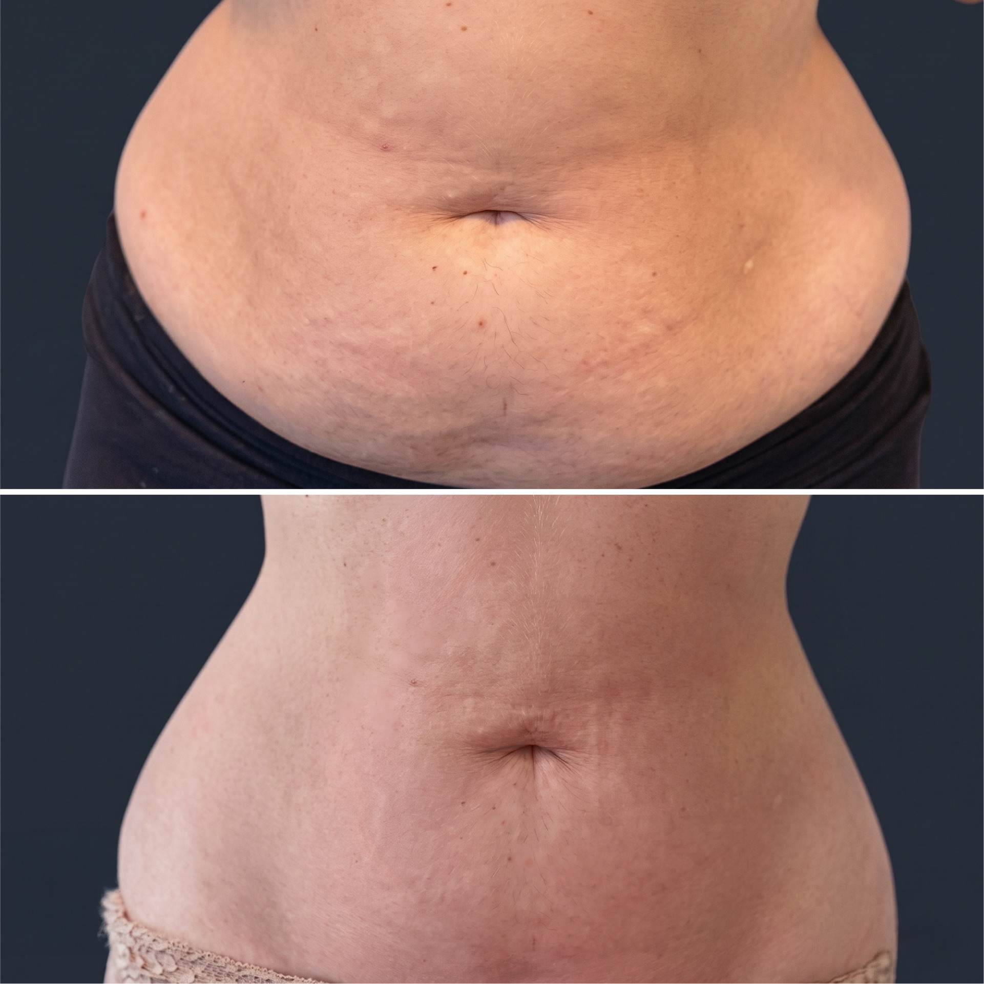 Exion Body antes e depois
