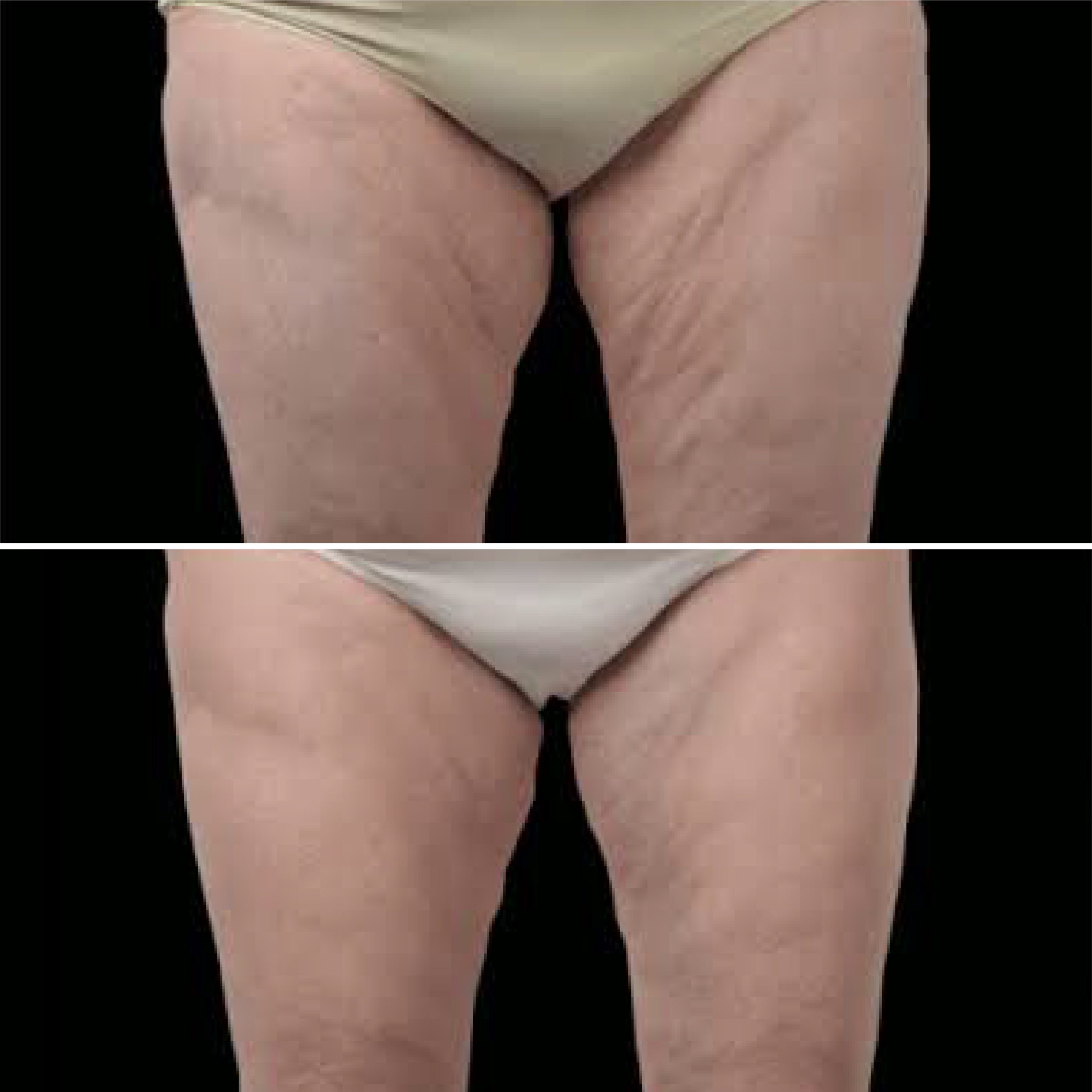 Antes e depois de tratamento EXION Body para flacidez nas pernas