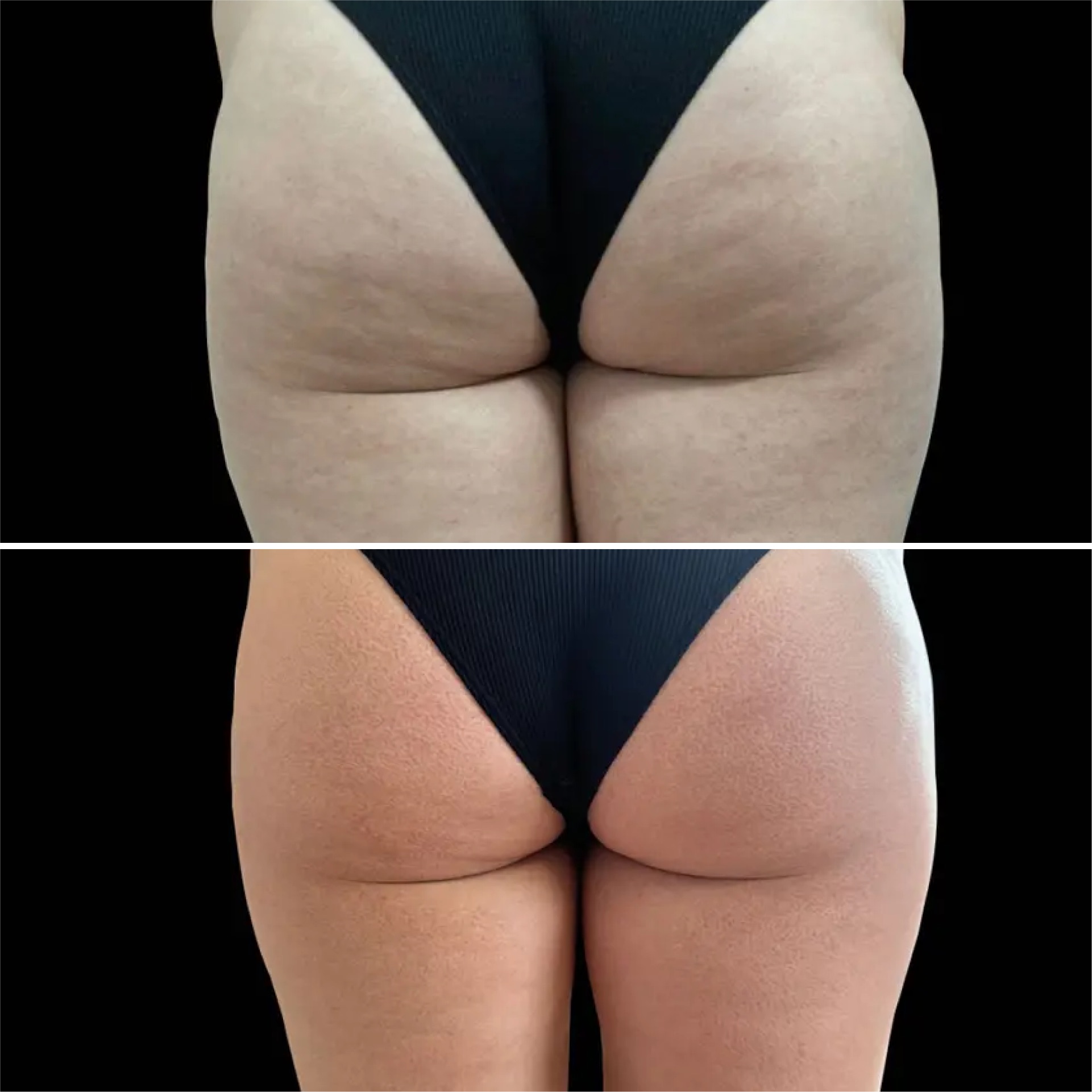 Exion Body antes e depois 2