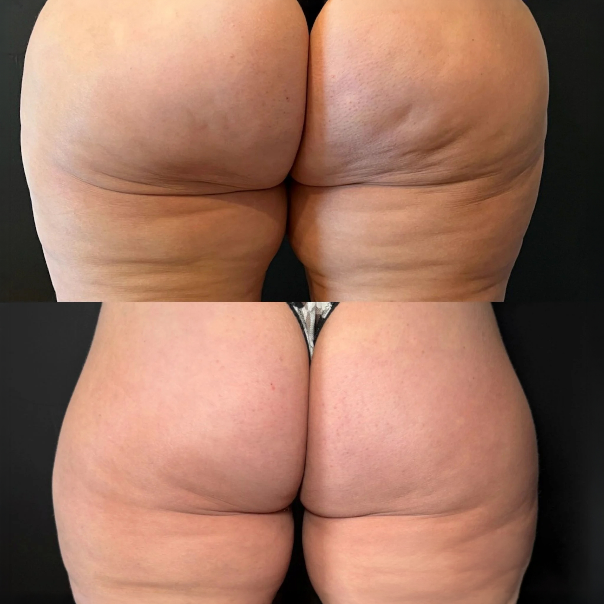 Antes e depois de tratamento EXION Body nos glúteos para gordura localizada e aparência da celulite