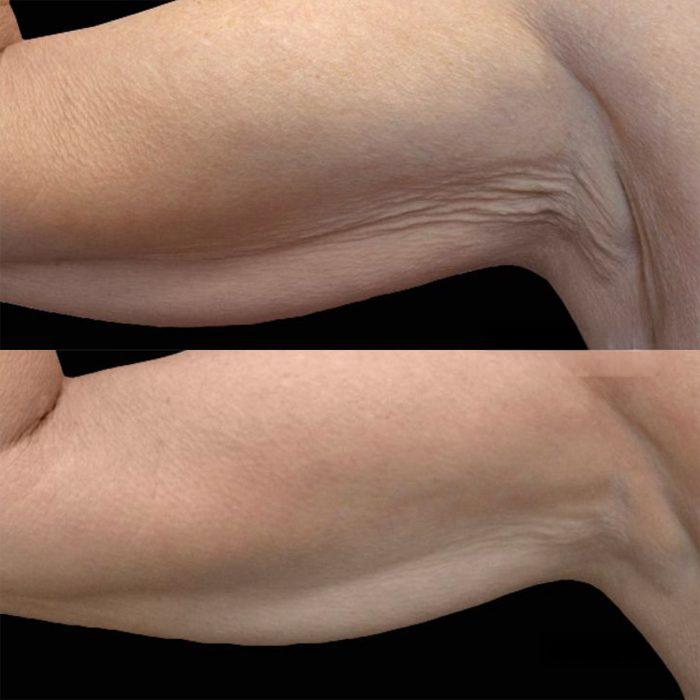 Antes e depois de tratamento EXION Body nos braços para gordura localizada e flacidez