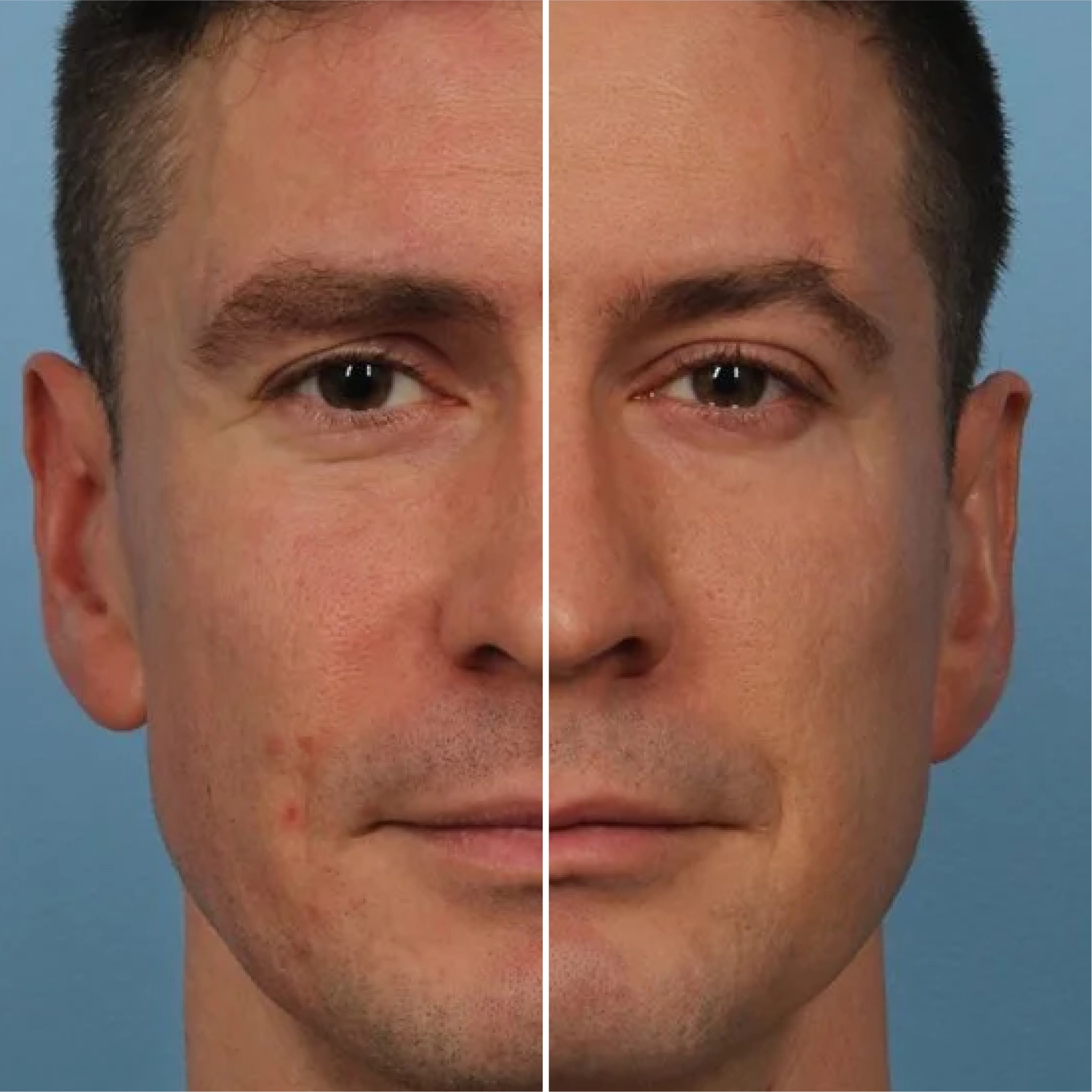 Exion Clear RF antes e depois
