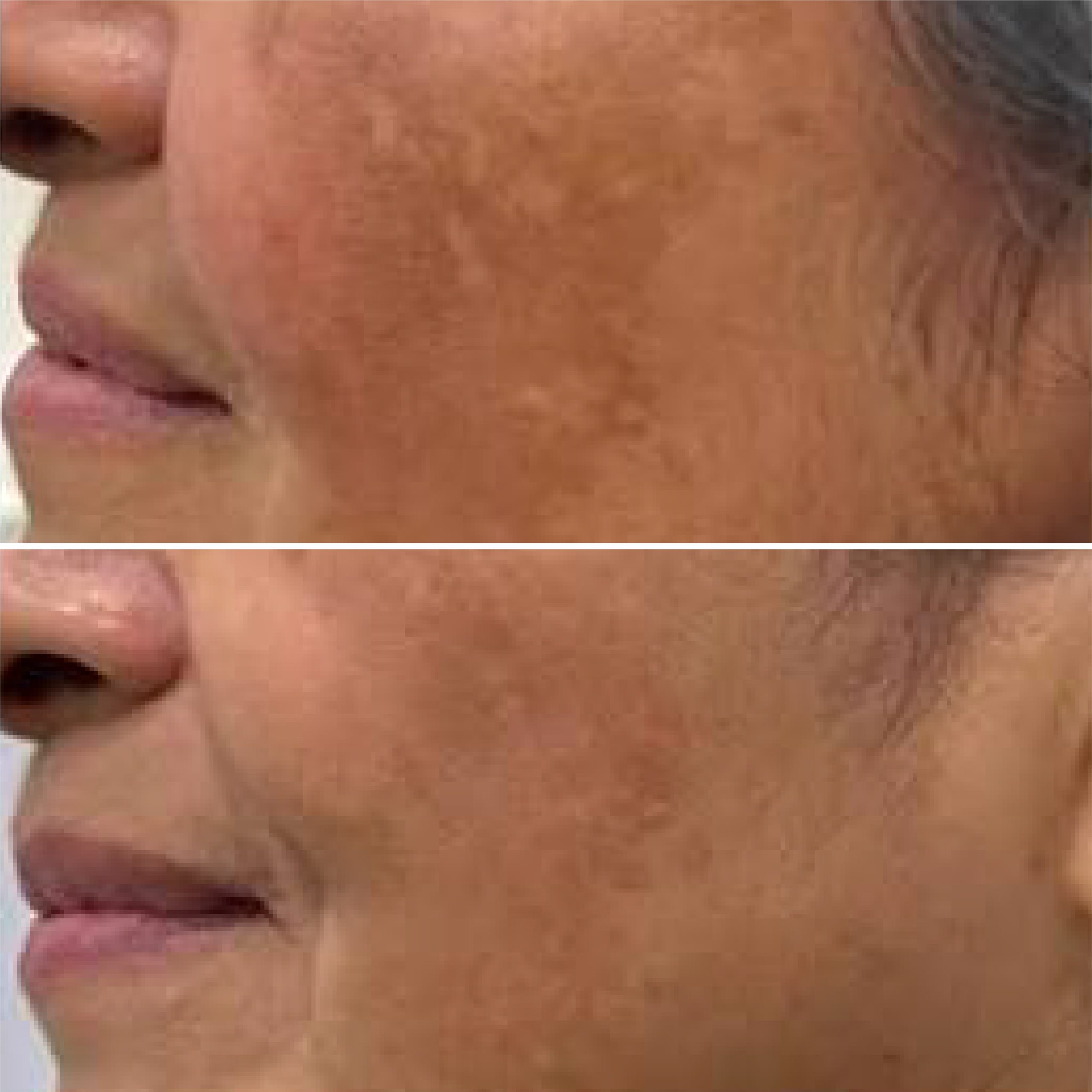 Clear RF antes e depois