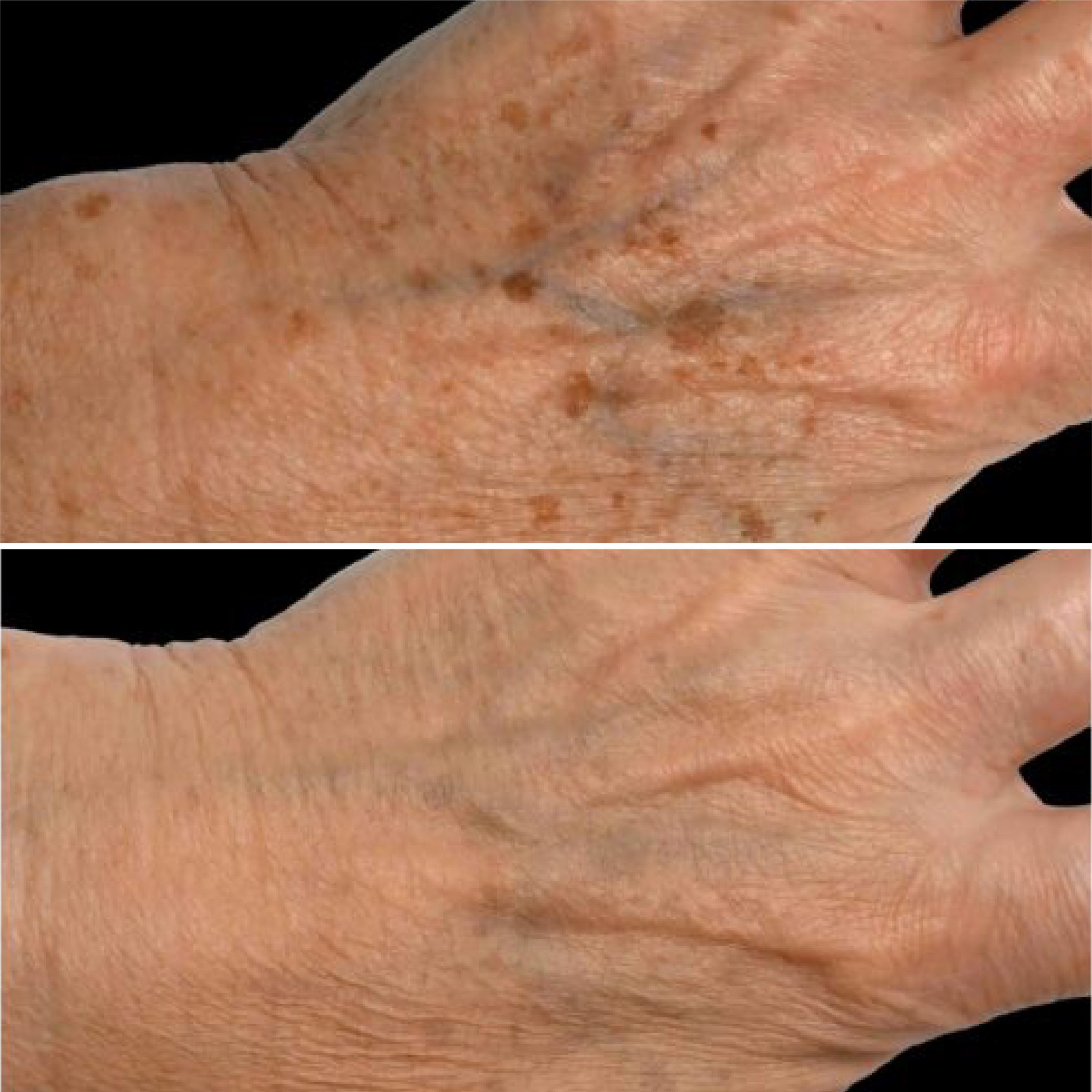 Clear RF antes e depois