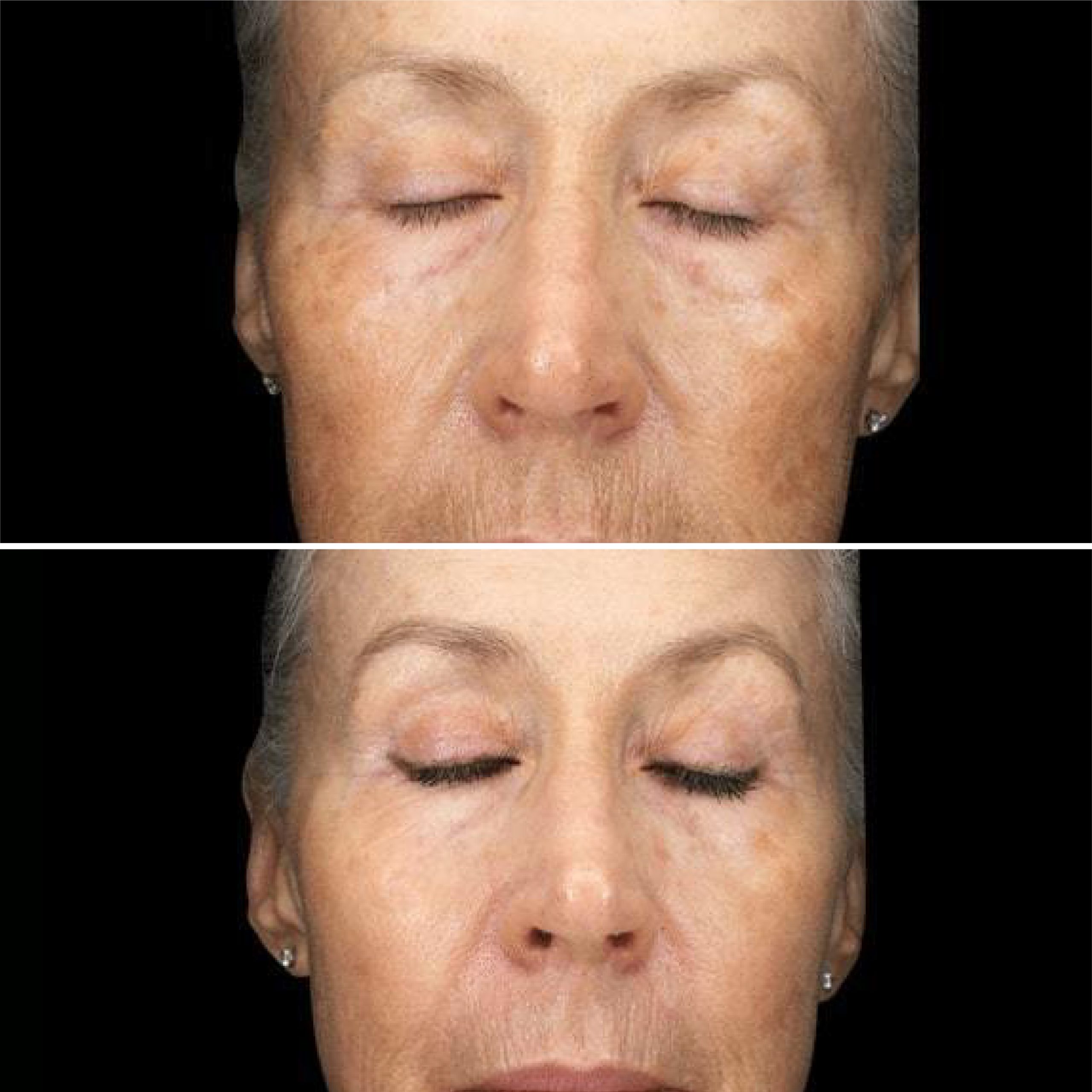 Clear RF antes e depois