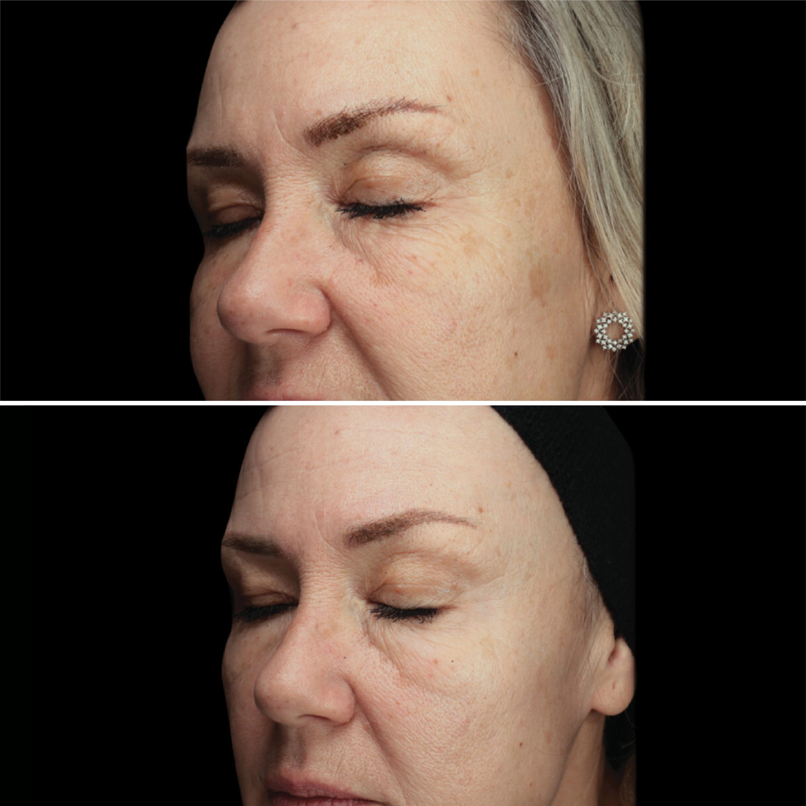 Clear RF antes e depois