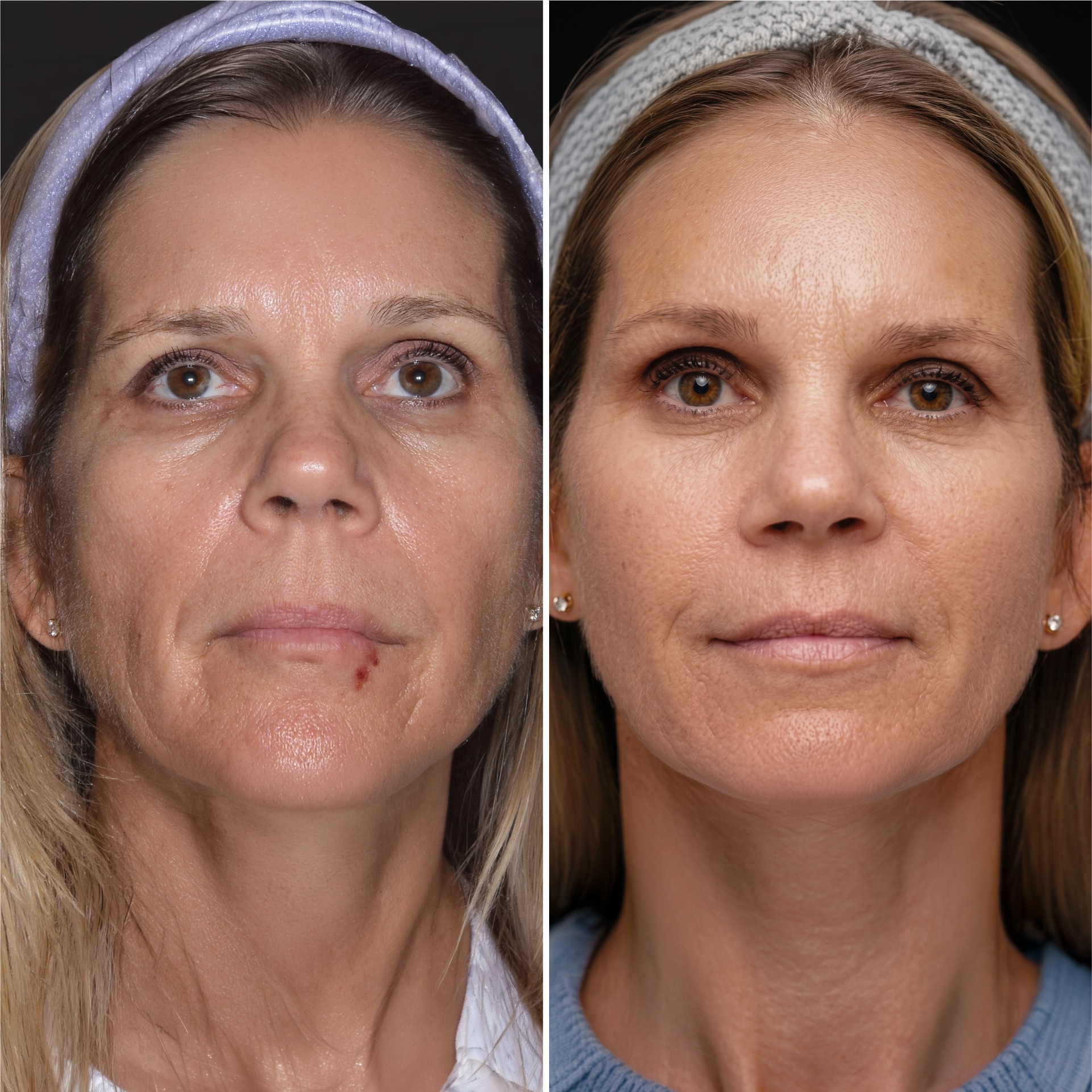 Exion RF Fracionado antes e depois