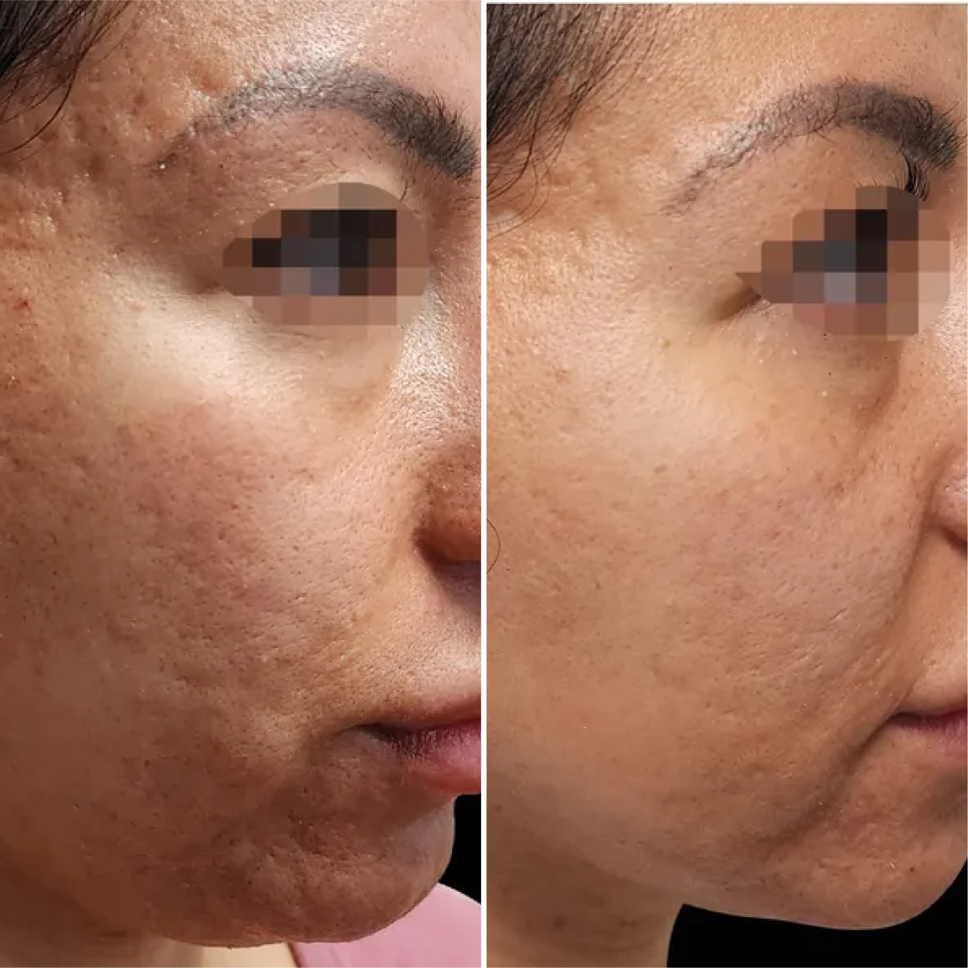 Exion RF Fracionado antes e depois 2