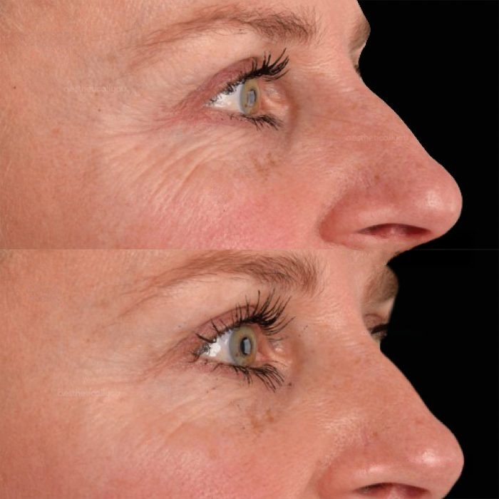 EXION RF Microagulhado antes e depois