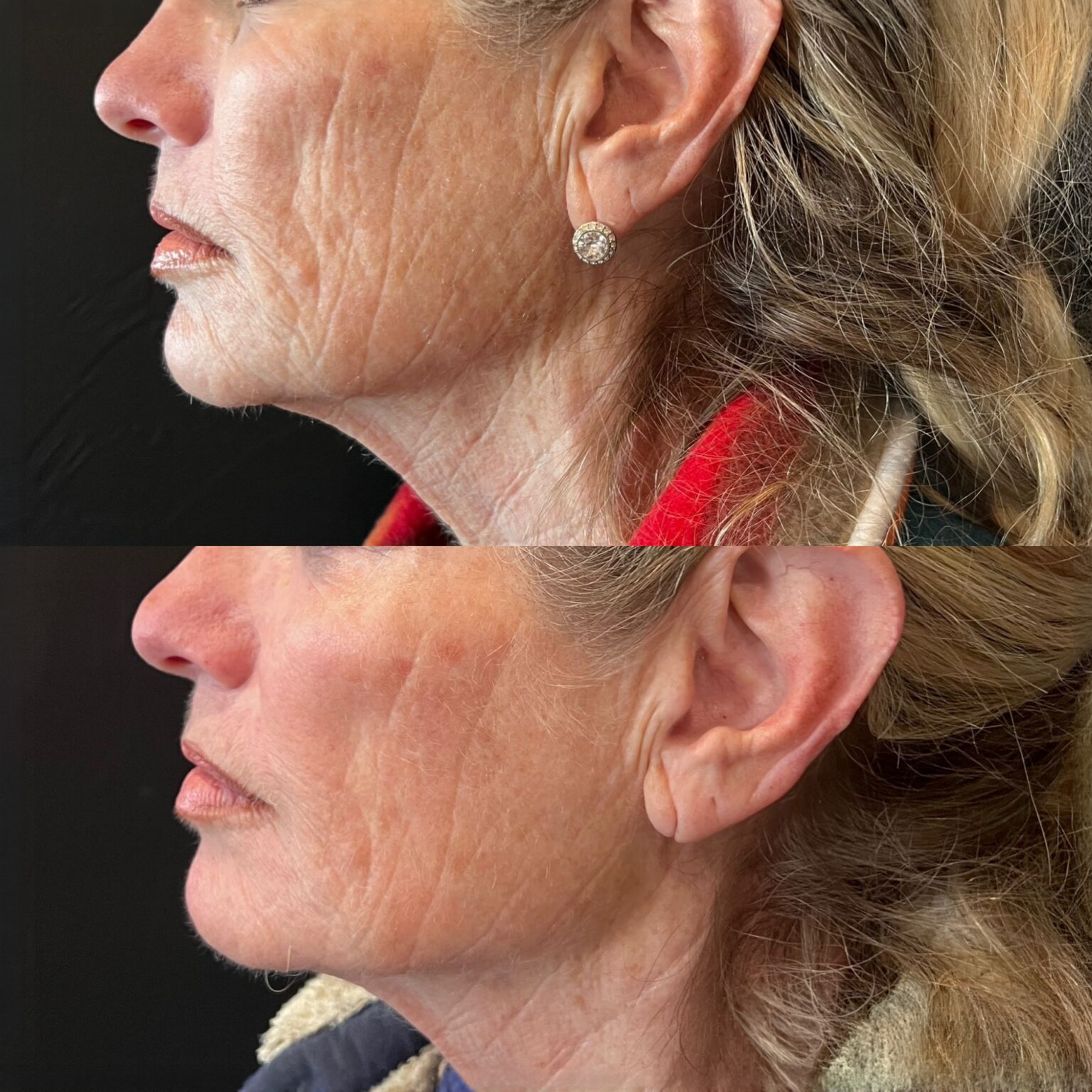RF Fracionado antes e depois