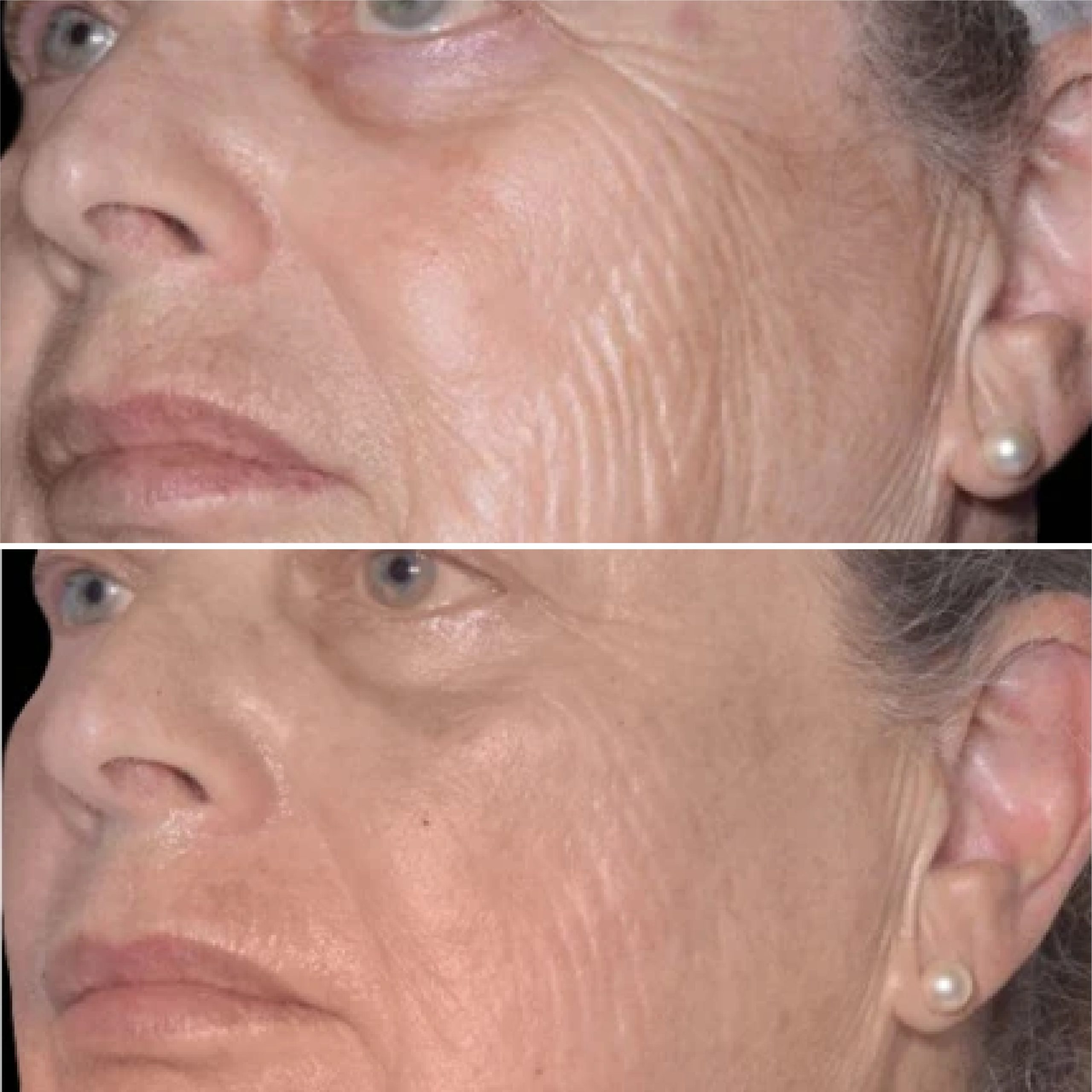 EXION RF Microagulhado antes e depois